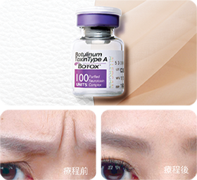 進行Botox 肉毒桿菌素注射療程後, 放鬆肌肉, 撫平動態紋, 去皺效果