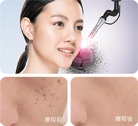 進行皮秒激光去斑療程, Pico laser, 美白, 去斑