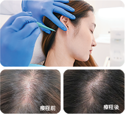 進行RGA微創移植細胞活髮療程後, 改善脫髮 生髮 效果