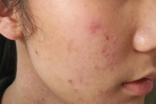 夏日皮膚易敏感原因4：光過敏 有光敏感的人，在日照後有可能會出現蕁麻疹或水泡等症狀，原因有以下2個：  1/ 有機是服用藥物中，某些藥物成分對光敏感的，可找醫生查詢。  2/ 相關患者塗防曬當然是必需的，還要穿著長袖衣褲防曬，戴上帽子或墨鏡為全身作出保護。