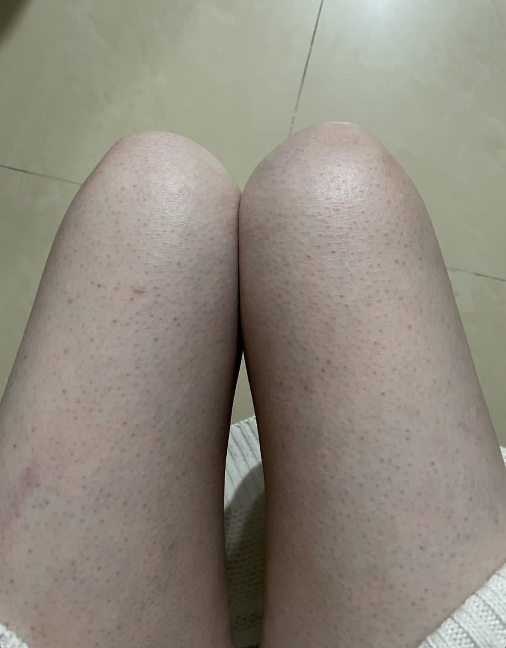 毛囊角化類型4/ 粗糙的褐色 如果你皮膚粗糙加上有密集式的褐色粒粒就屬於丘疹型，這需要找皮膚科醫生幫手了。